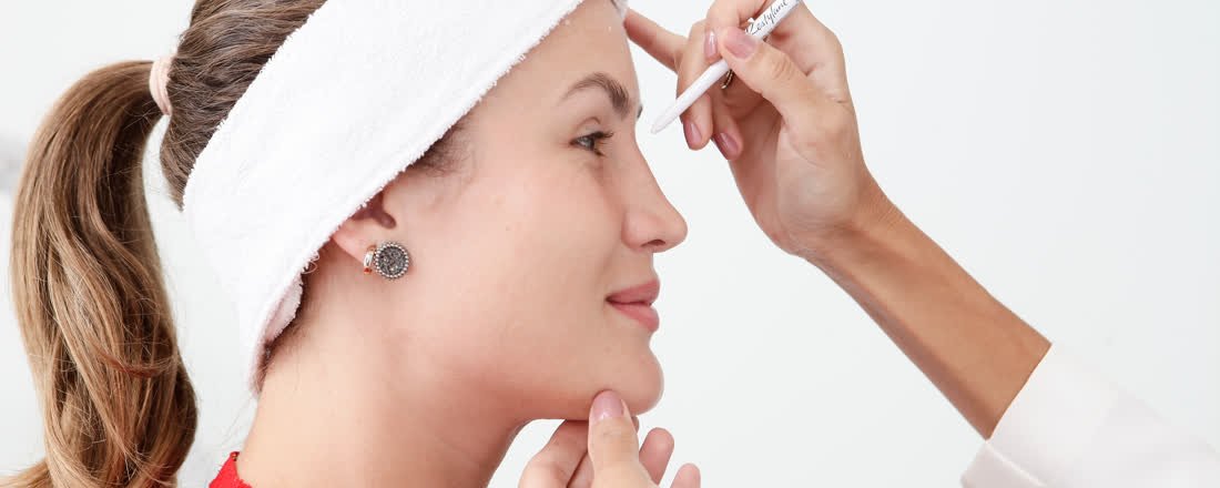 Marcação facial antes de aplicação de preenchimento com ácido hialurônico