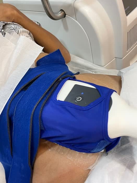 Aplicador de criolipólise (Coolsculpting) na região abdominal