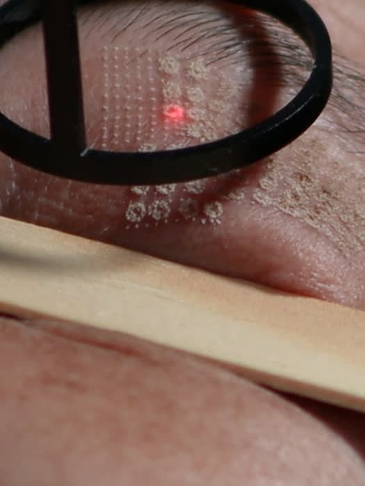 Aplicação de laser Hybrid CO2 fracionado na pele