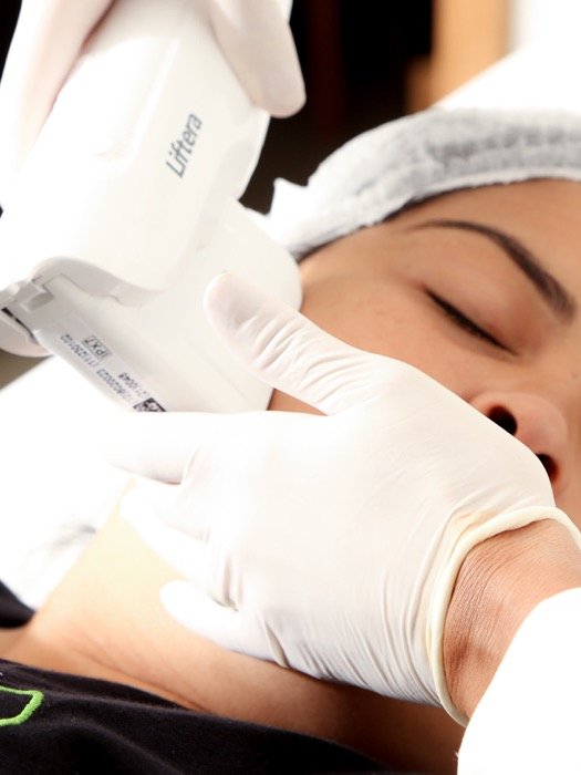 Aplicação de ultrassom microfocado Liftera no rosto da paciente